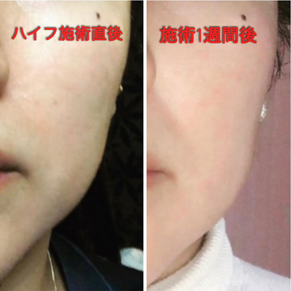 ハイフ