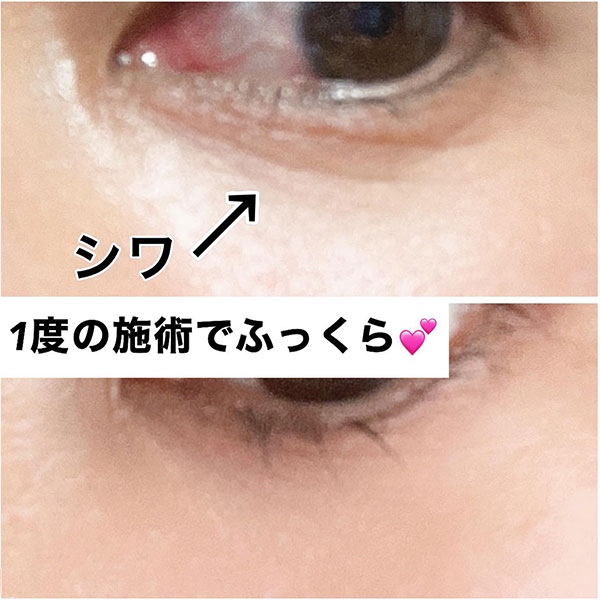 ハイフ
