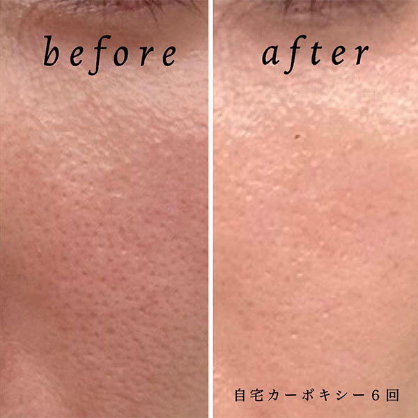 自宅カーボキシー