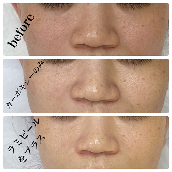 カーボキシー+ラミネーションピール 