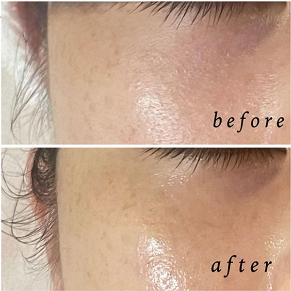 Cserum イオン導入１回