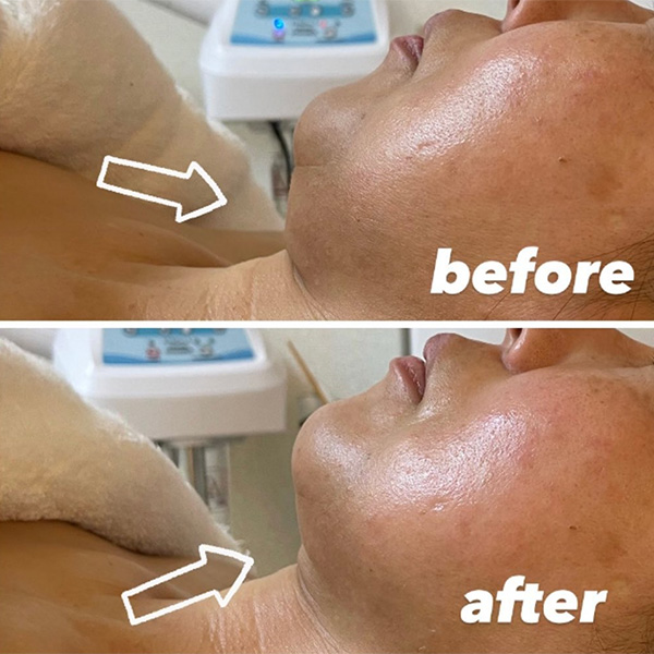 オリジナル手技にハイフ