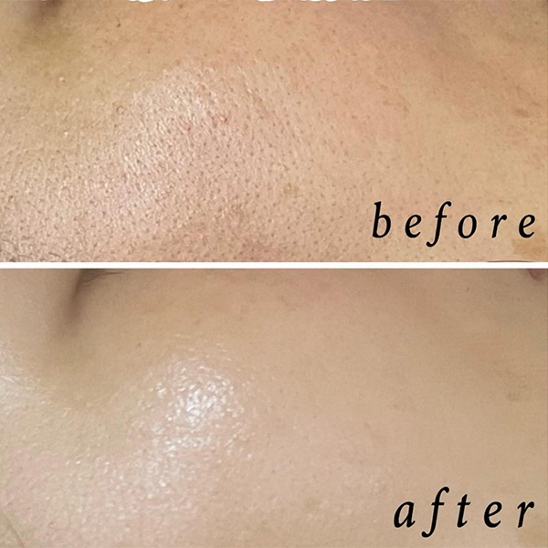 イオン導入 炭酸泡パック