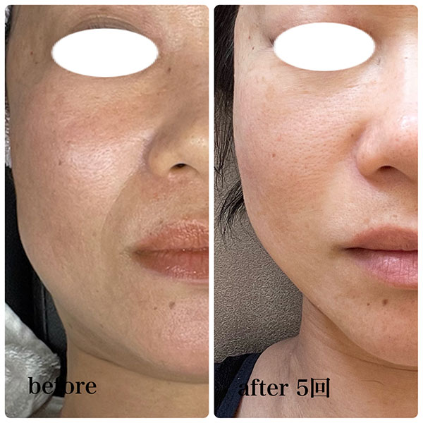 ラミネーションピール 