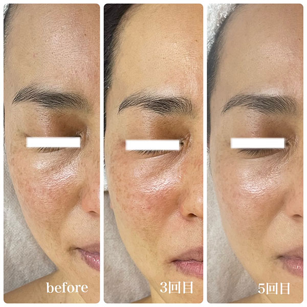 ラミネーションピール 