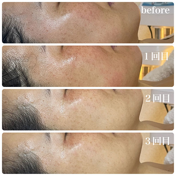 ラミネーションピール 